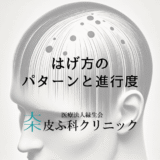 はげ方のパターンと進行度｜種類別の治療アプローチ