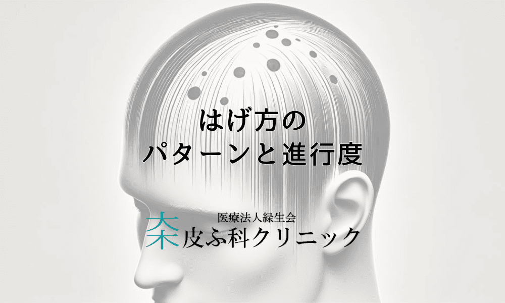 はげ方のパターンと進行度｜種類別の治療アプローチ
