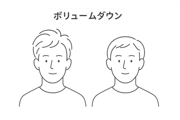 AGA軟毛化 – ボリュームダウンした髪のイラスト