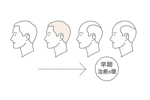 AGA進行パターンと治療タイミング図