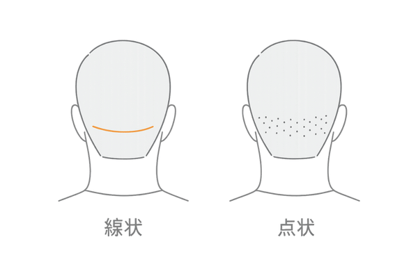 FUEとFUTの傷跡・痛み比較イメージ