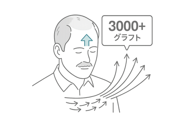 広範囲薄毛に対するFUTの大規模移植イメージ