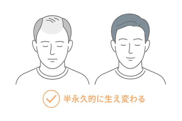 AGA影響部位と自毛植毛効果の対比イラスト