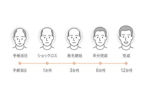 自毛植毛手術から1年後までのタイムライン