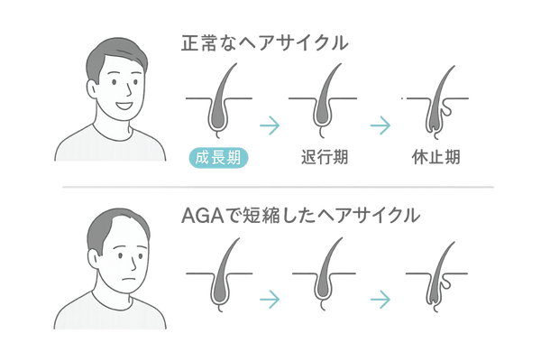 AGAヘアサイクル正常と乱れ比較図