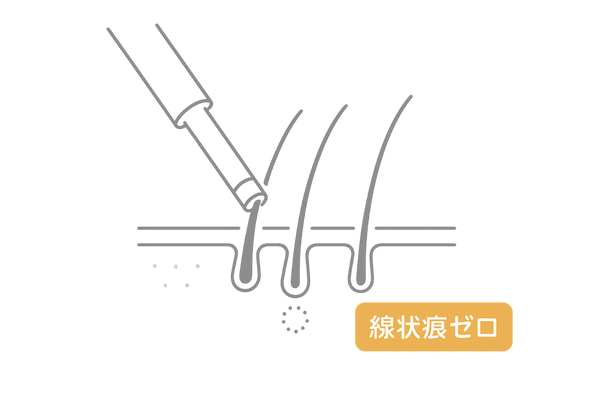 FUEパンチで毛包を1本ずつ採取