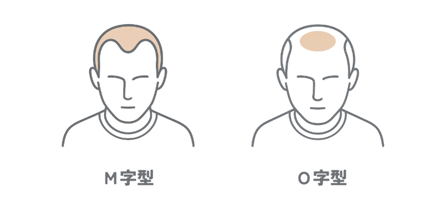 「M字型」「O字型」