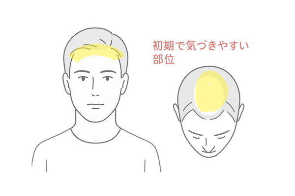 AGA初期(生え際と頭頂部)の変化が出やすい部位の図