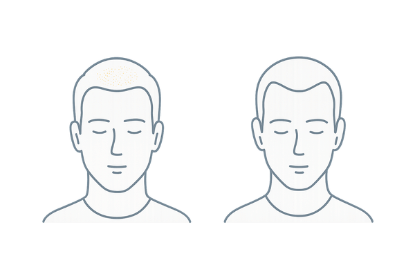 O字型（頭頂部）とM字型（生え際）の違い