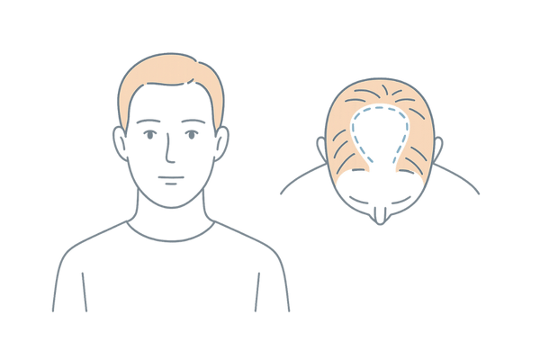 遺伝パターンの典型(生え際M字・頭頂部パターン)