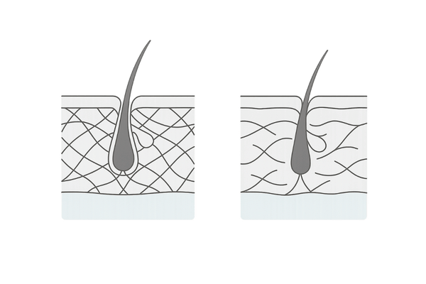 頭皮コラーゲン減少と毛包の萎縮|支持力低下イメージ