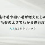 短い抜け毛や細い毛が増えたらAGA？毛髪の太さでわかる進行度