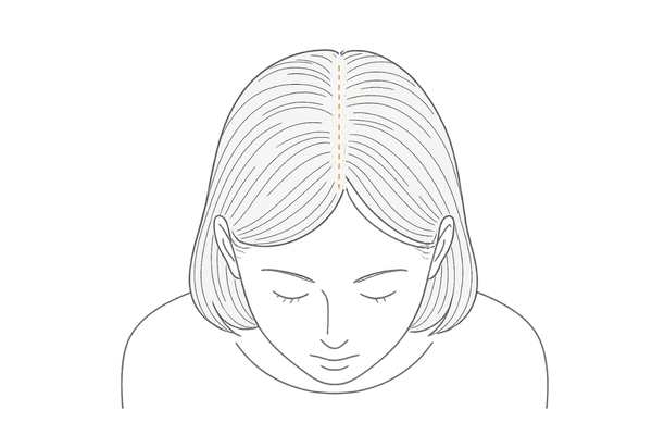 女性の薄毛の特徴|びまん性脱毛症の図解(分け目の透け・ボリューム低下)