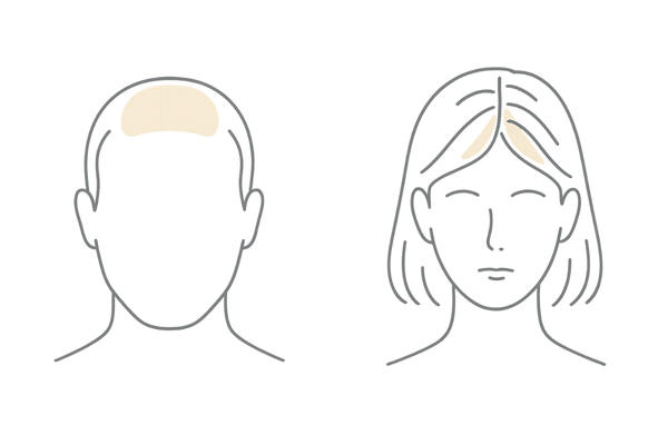 男性の薄毛との違い|AGAの局所型と女性びまん性の比較図