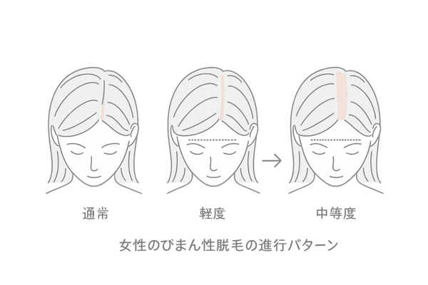 びまん性脱毛の進行パターン可視化(女性)