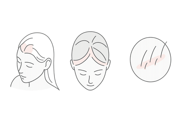 FUEが向く女性薄毛タイプ:生え際・分け目・瘢痕