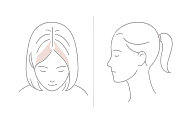 女性の生え際が薄くなる主な病型の見分け方