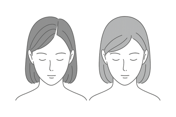 女性薄毛の適応例と非適応例(局所薄毛 vs びまん性脱毛症)