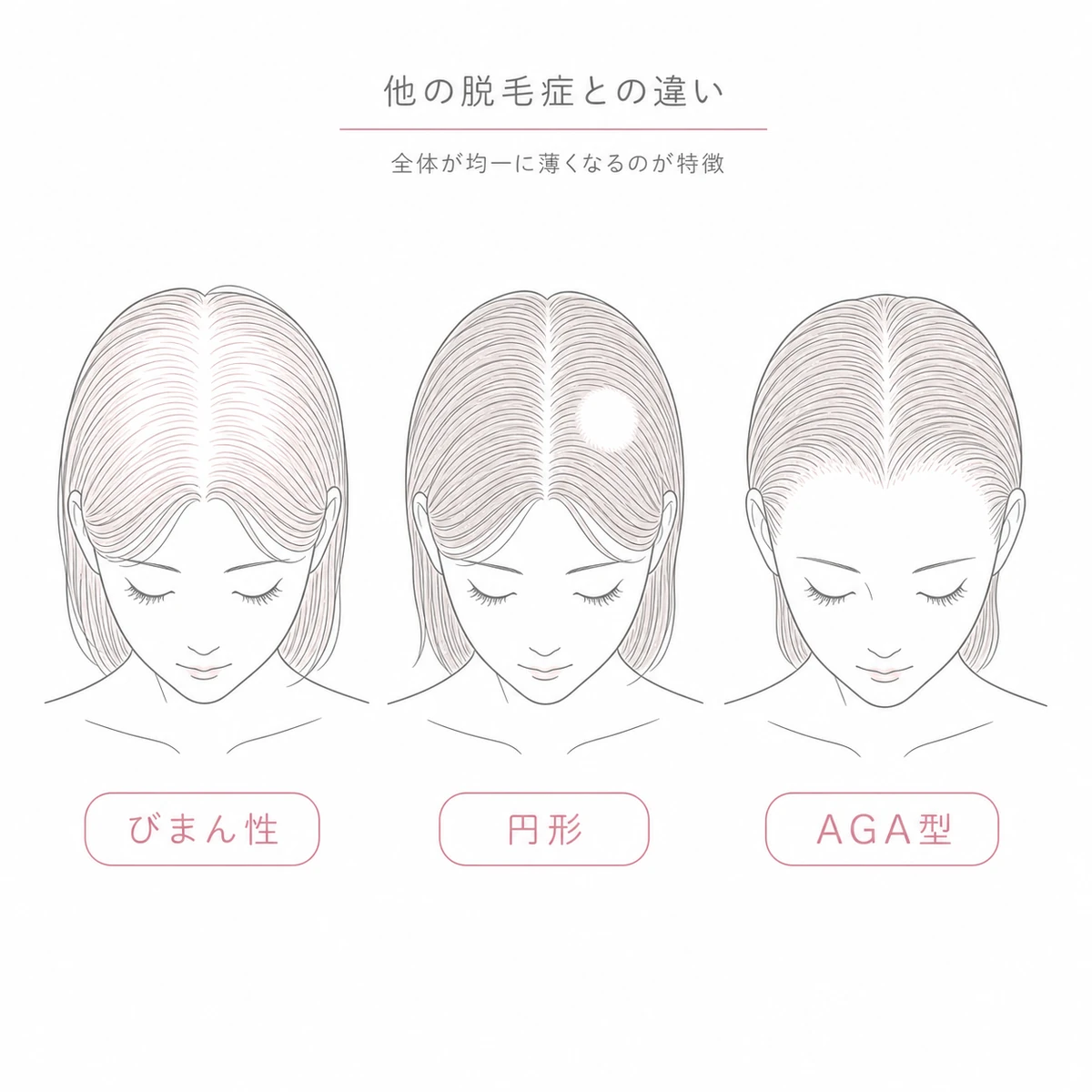 びまん性脱毛症・円形脱毛症・AGA型の薄毛パターンの違いを3つの女性の頭で比べた線画イラスト