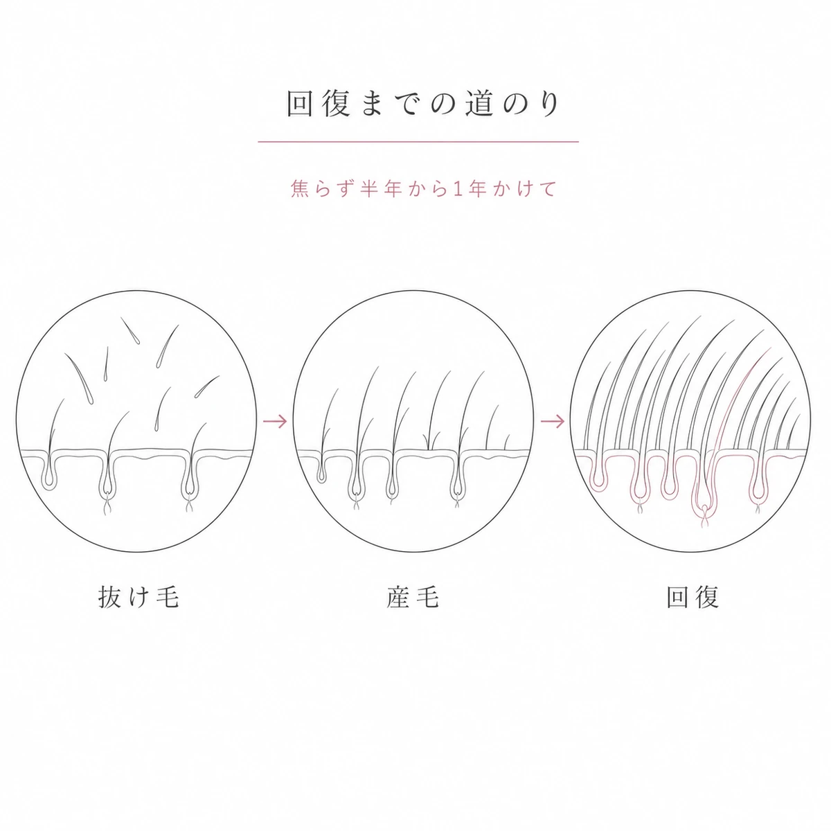 抜け毛から産毛を経てボリュームが戻る回復の流れを段階で表した線画イラスト