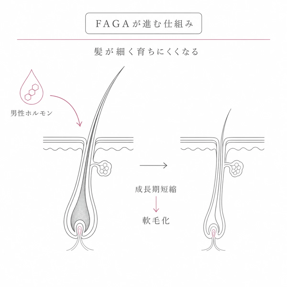 男性ホルモンの影響で毛根の成長期が短くなり髪が軟毛化するFAGAの仕組みを表した線画イラスト