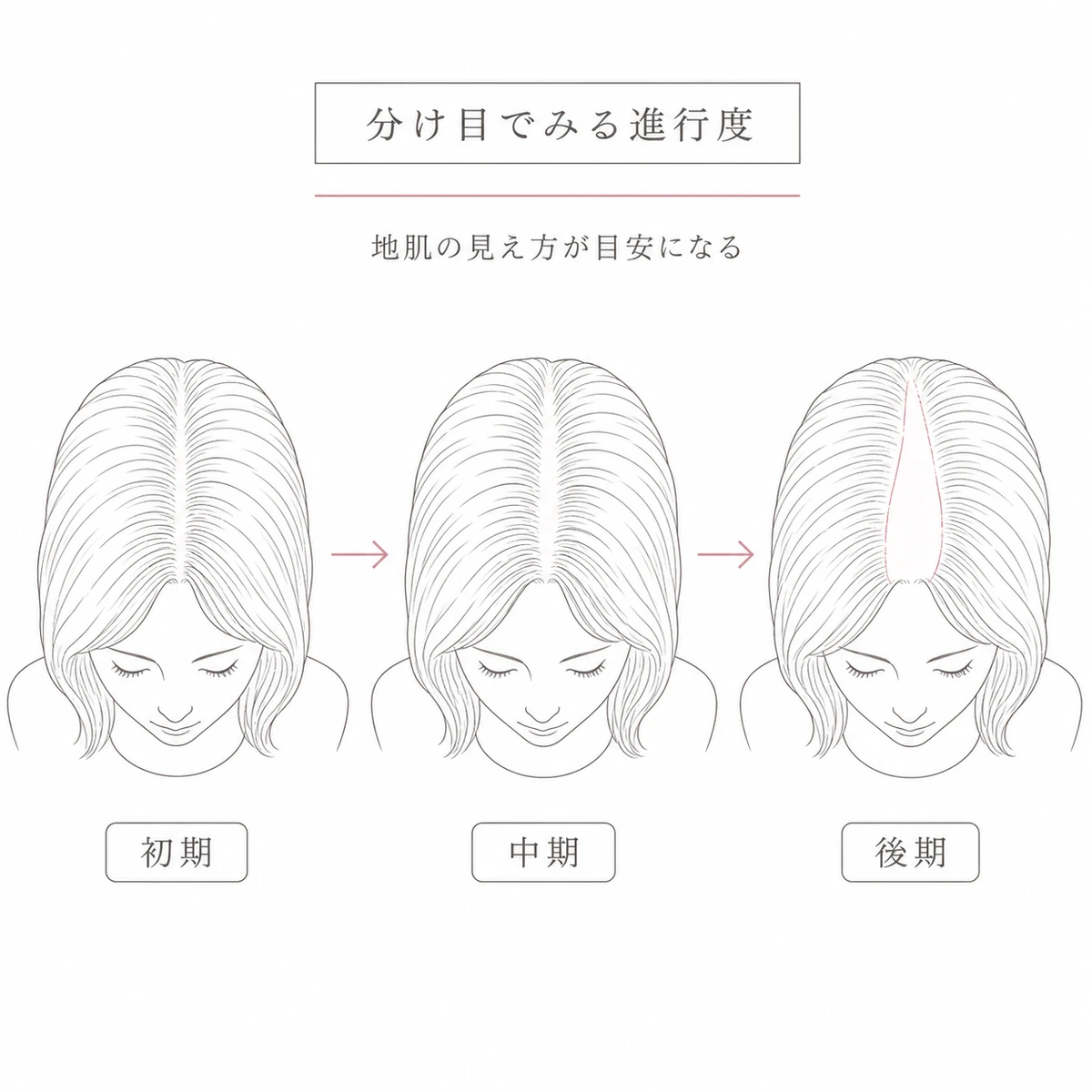 分け目の広がりが初期から後期へ進むFAGAの進行度を頭頂部で段階的に表した線画イラスト