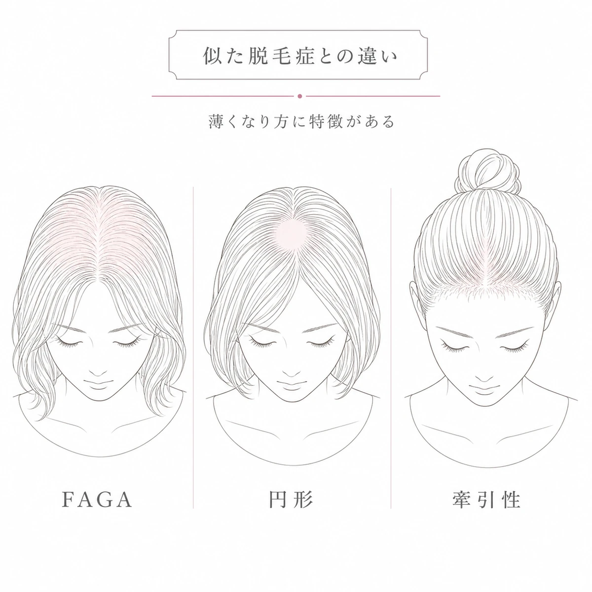 FAGAと円形脱毛症と牽引性脱毛症の薄くなり方の違いを3つの女性の頭で比べた線画イラスト