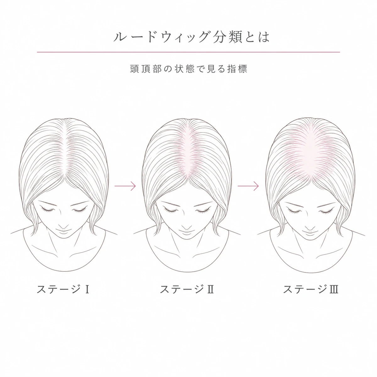 頭頂部の薄毛が3つのステージに分かれるルードウィッグ分類の全体像を表した線画イラスト