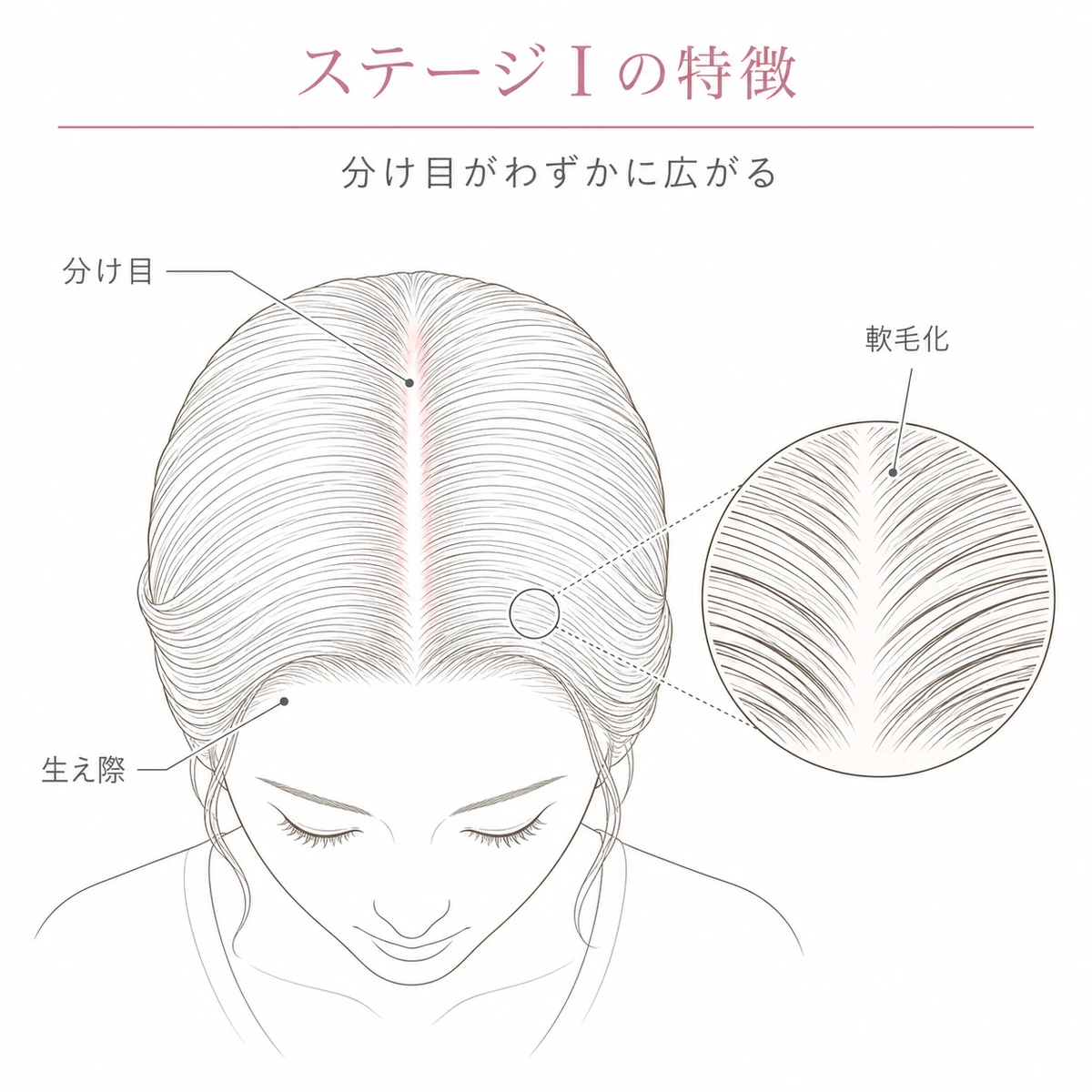 分け目がわずかに広がり髪が細くなり始めるステージⅠの頭頂部の状態を表した線画イラスト