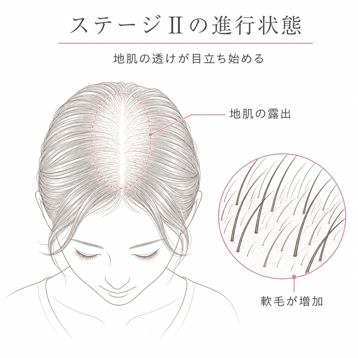 分け目周辺の地肌が広く透け軟毛が増えるステージⅡの頭頂部の状態を表した線画イラスト