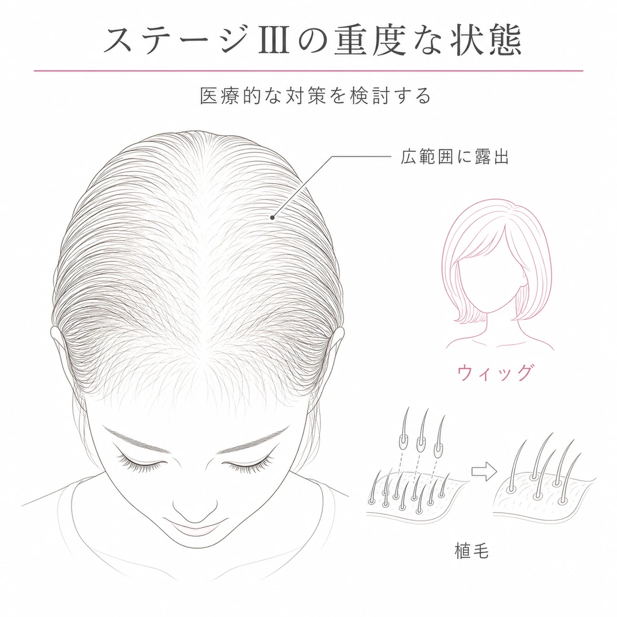 頭頂部が広範囲に露出しウィッグや植毛を検討するステージⅢの重度な薄毛の状態を表した線画イラスト