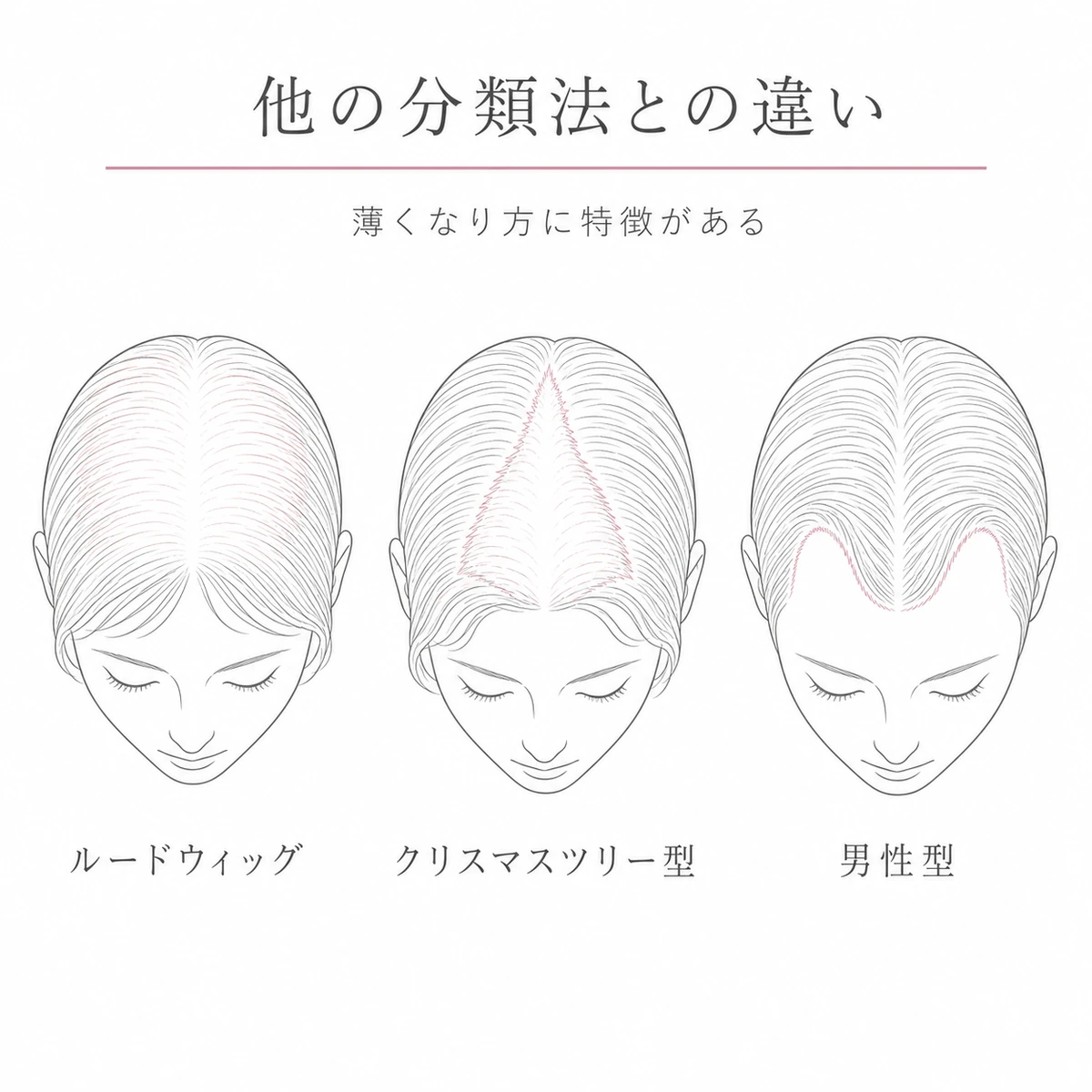 ルードウィッグ分類とクリスマスツリー型と男性型の薄毛パターンの違いを3つの頭で比べた線画イラスト