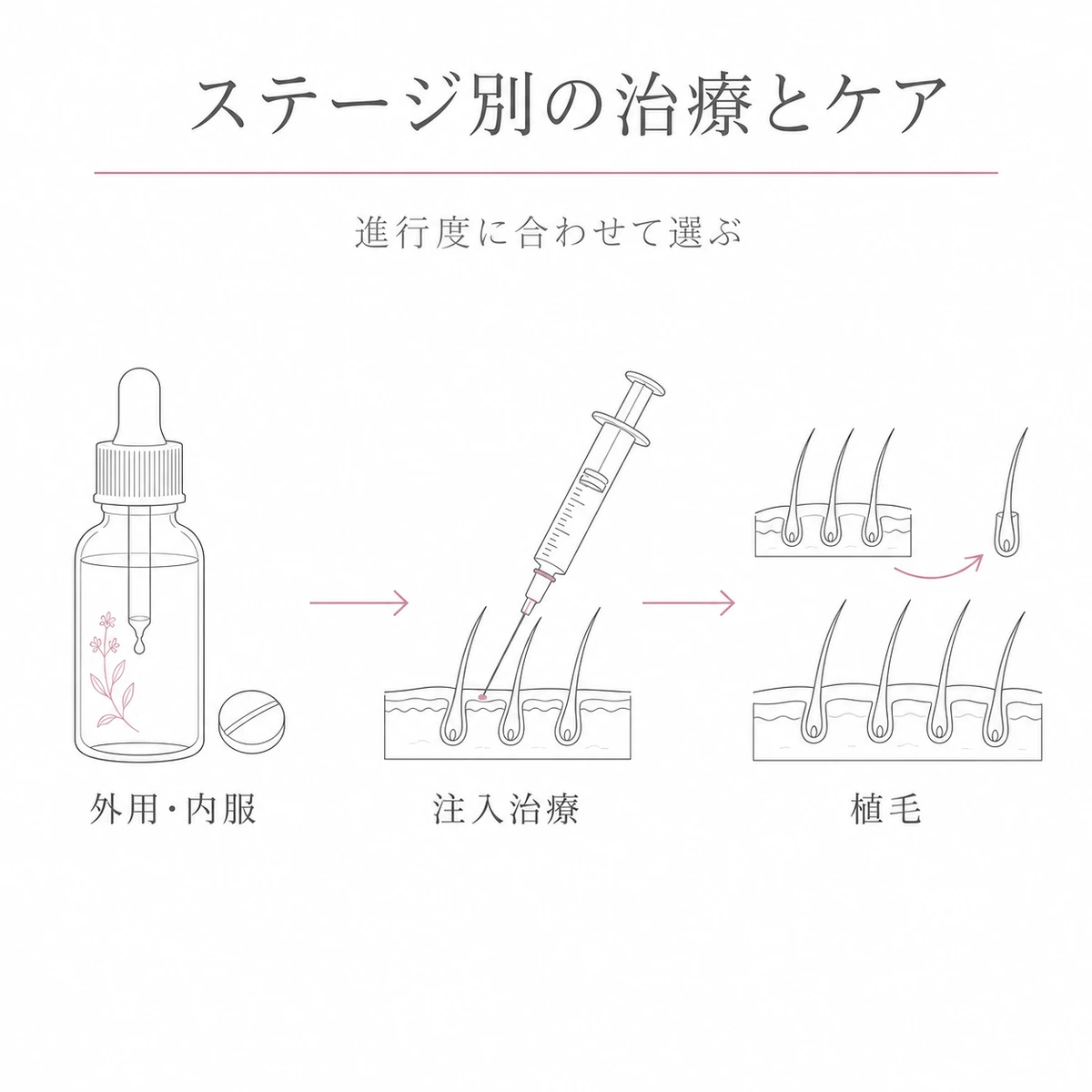 外用や内服から注入治療や植毛へと進行度に応じて選ぶFAGA治療の流れを表した線画イラスト