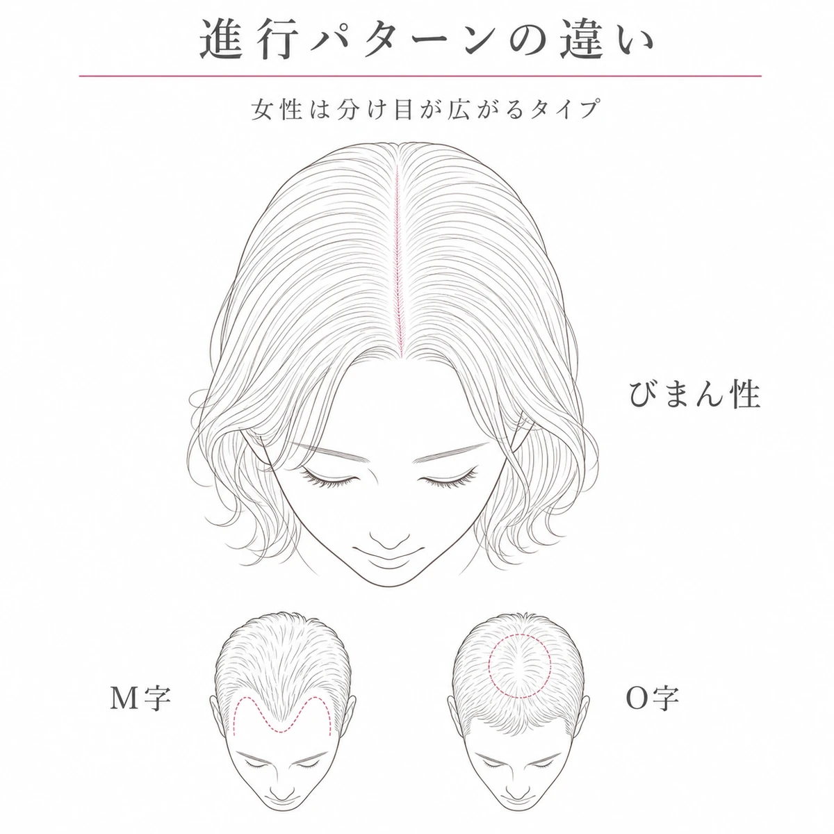女性のびまん性脱毛と男性のM字O字型の進行パターンの違いを頭部で比べた線画イラスト