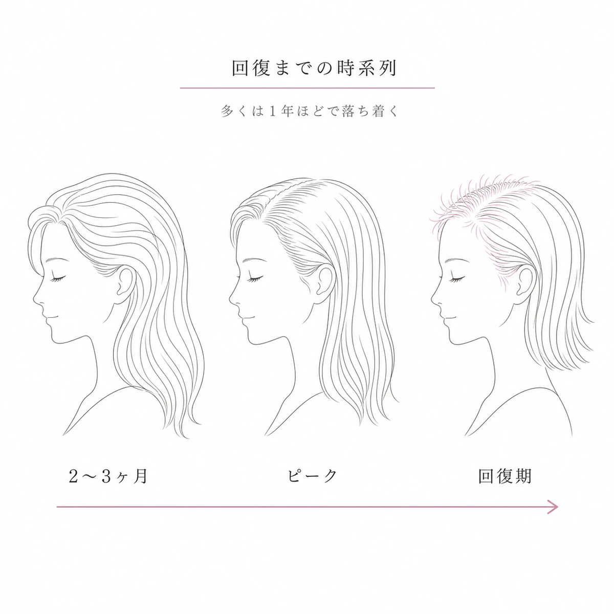 産後の抜け毛が始まりからピークを経て回復へ向かう毛量の移り変わりを3段階で表した線画イラスト