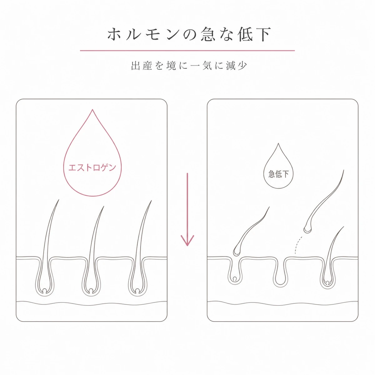 妊娠中に満ちていた女性ホルモンが出産後に急低下し髪が抜けやすくなる変化を対比した線画イラスト