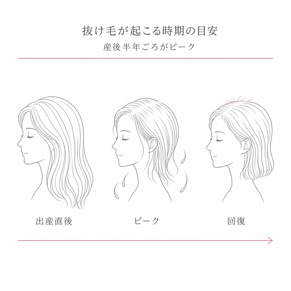 産後の抜け毛が出産直後からピークを経て回復へ向かう時期の流れを女性の頭で表した線画イラスト