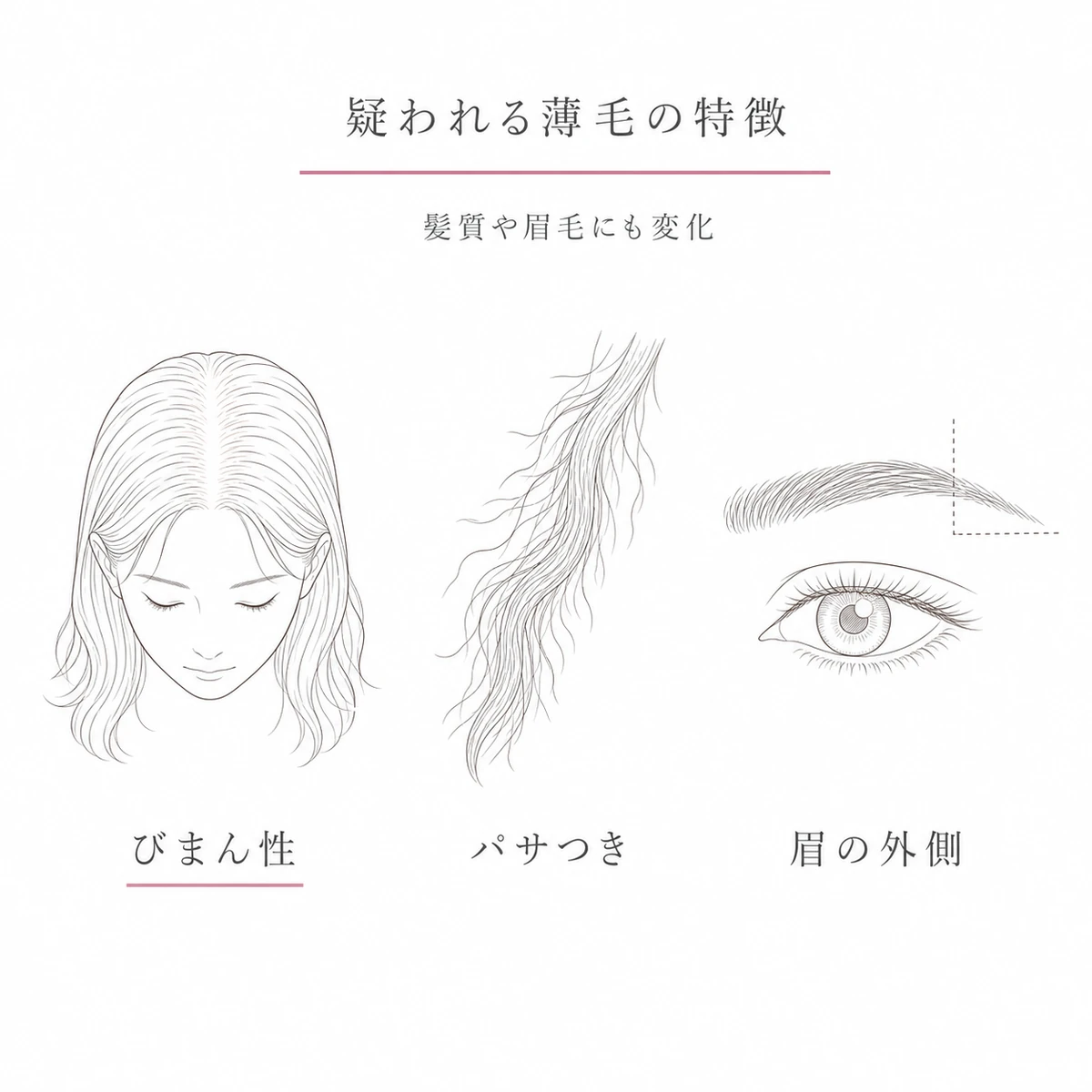 びまん性の薄毛やパサつきや眉毛の外側の変化など甲状腺由来の薄毛の特徴を表した線画イラスト