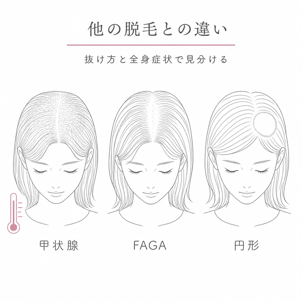 甲状腺由来とFAGAと円形脱毛の抜け方の違いを3つの女性の頭で比べた線画イラスト