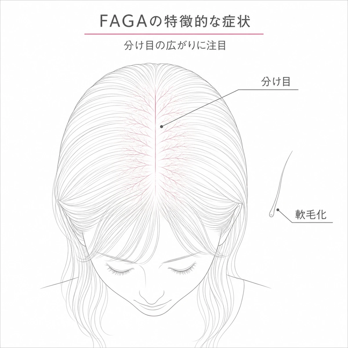 頭頂部の分け目が枝状に広がり髪が軟毛化するFAGA特有の症状を上から見た線画イラスト