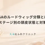 FAGAの進行度「ルードウィッグ分類」とは？ステージ別の頭皮状態と対策