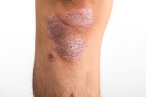 いんきんたむし・ぜにたむしの症状と治療|皮膚糸状菌と呼ばれるカビが原因