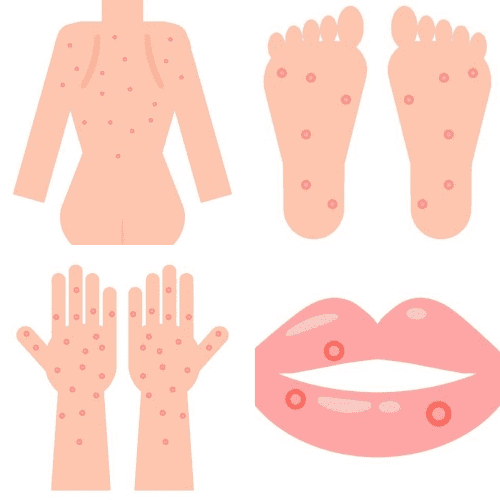 梅毒　症状　バラ疹　ばらしん　手足の発疹　身体の発疹　口の発疹　赤い