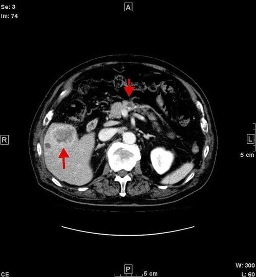 ct 肝臓がん　すい臓がん　胆管がん