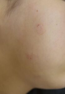いんきんたむし・ぜにたむしの症状と治療|皮膚糸状菌と呼ばれるカビが原因