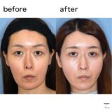 鼻の曲がり　修正手術　症例写真　モニター２