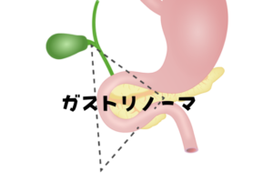 ガストリノーマ