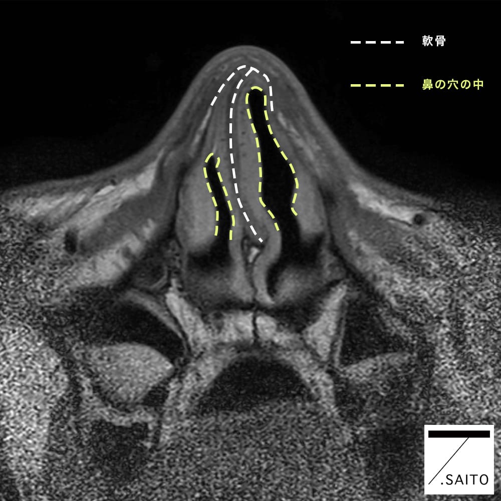 鼻中隔弯曲　CT画像