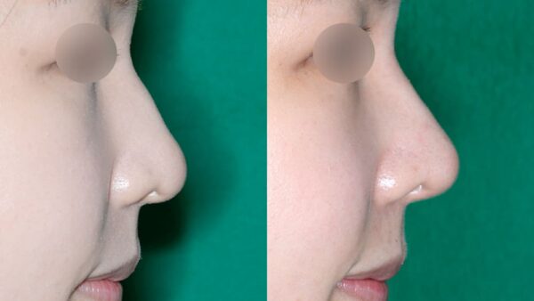 わし鼻の修正手術。プロテーゼ無しで鼻筋を整形したい人の２大ポイント