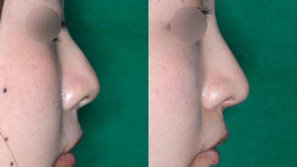 鼻整形前のセルフチェック！耳介軟骨だけで鼻尖形成ができる３つの条件